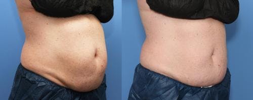 Body Before & After Gallery - Patient 58178480 - Image 2