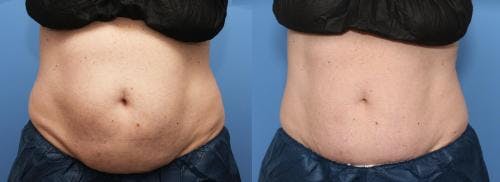 Body Before & After Gallery - Patient 58178480 - Image 3
