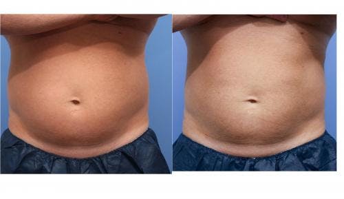 Body Before & After Gallery - Patient 58178482 - Image 2