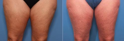 Thighs Before & After Gallery - Patient 58178483 - Image 1