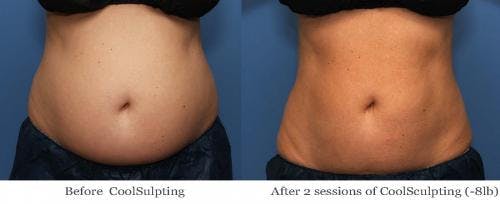 Body Before & After Gallery - Patient 58178487 - Image 1