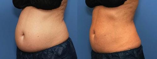 Body Before & After Gallery - Patient 58178487 - Image 2