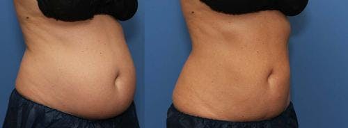 Body Before & After Gallery - Patient 58178487 - Image 3