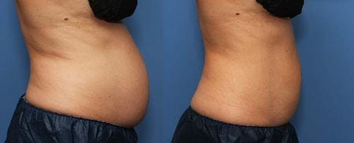 Body Before & After Gallery - Patient 58178487 - Image 4