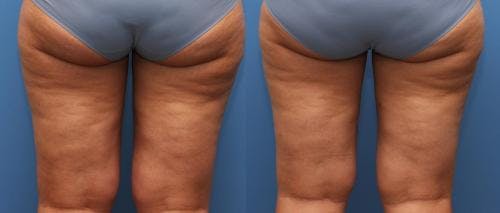 Thighs Before & After Gallery - Patient 58178486 - Image 2