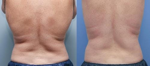 Body Before & After Gallery - Patient 58178491 - Image 1