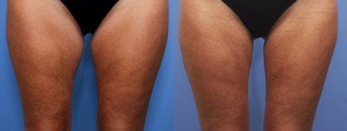 Thighs Before & After Gallery - Patient 58178488 - Image 2