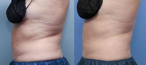 Body Before & After Gallery - Patient 58178491 - Image 2