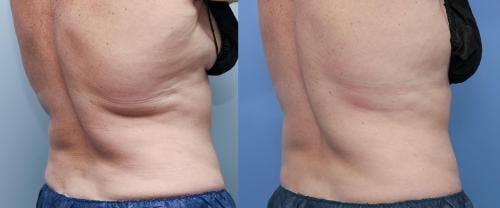Body Before & After Gallery - Patient 58178491 - Image 3