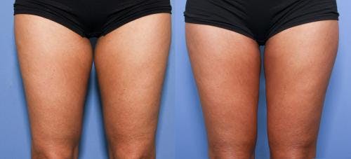 Thighs Before & After Gallery - Patient 58178490 - Image 1