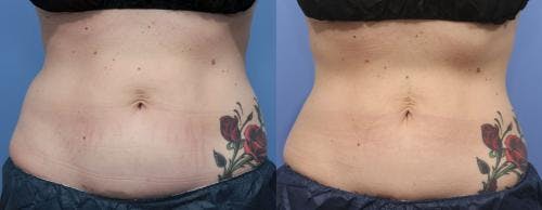 Body Before & After Gallery - Patient 58178493 - Image 3