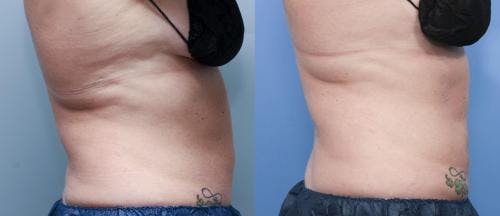Body Before & After Gallery - Patient 58178495 - Image 4