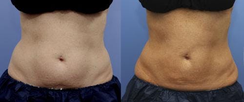 Body Before & After Gallery - Patient 58178496 - Image 1