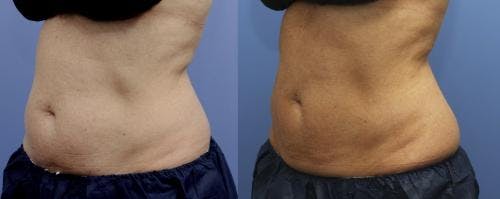 Body Before & After Gallery - Patient 58178496 - Image 2
