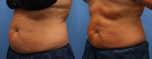 Body Before & After Gallery - Patient 58178501 - Image 2