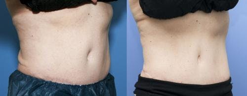 Body Before & After Gallery - Patient 58178503 - Image 1