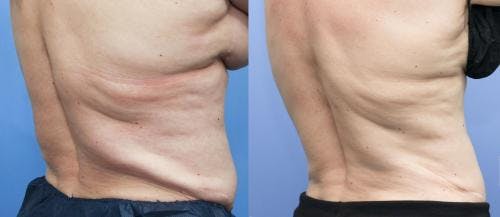 Body Before & After Gallery - Patient 58178503 - Image 2