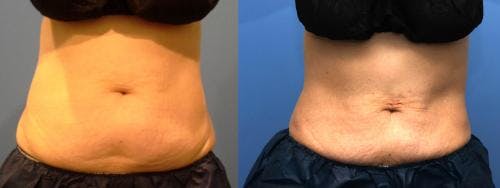 Body Before & After Gallery - Patient 58178507 - Image 1