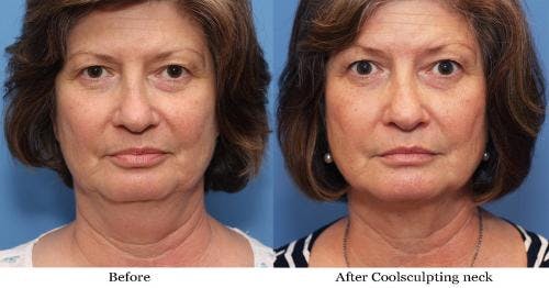 Neck Before & After Gallery - Patient 58178509 - Image 1
