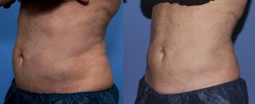 Body Before & After Gallery - Patient 58178510 - Image 1