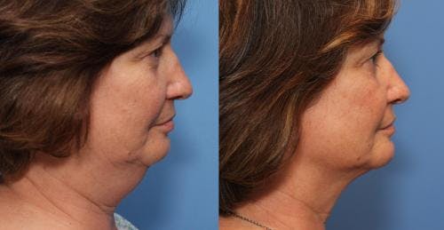 Neck Before & After Gallery - Patient 58178509 - Image 2