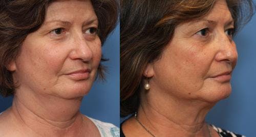 Neck Before & After Gallery - Patient 58178509 - Image 3