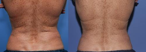 Body Before & After Gallery - Patient 58178510 - Image 3