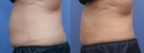 Body Before & After Gallery - Patient 58178512 - Image 2