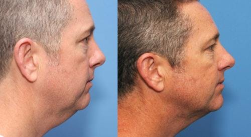 Neck Before & After Gallery - Patient 58178511 - Image 3