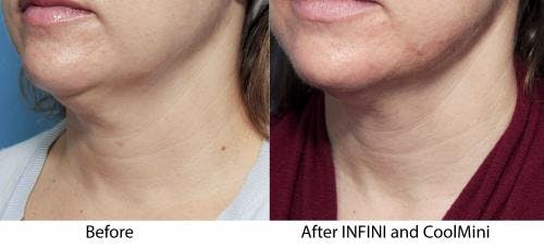 Neck Before & After Gallery - Patient 58178515 - Image 1