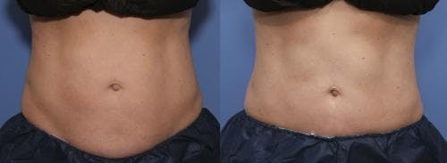 Body Before & After Gallery - Patient 58178517 - Image 1