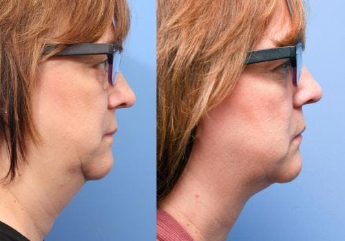 Neck Before & After Gallery - Patient 58178516 - Image 1