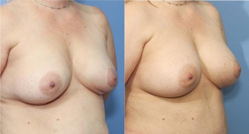 Breast Revision Before & After Gallery - Patient 58179101 - Image 2