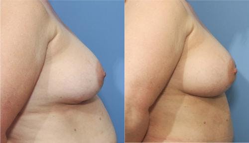 Breast Revision Before & After Gallery - Patient 58179101 - Image 3