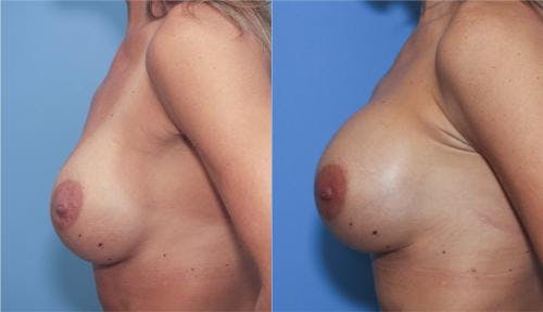 Breast Revision Before & After Gallery - Patient 58179102 - Image 2