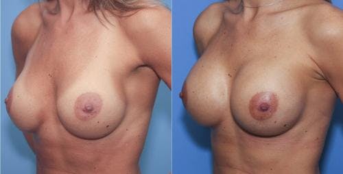 Breast Revision Before & After Gallery - Patient 58179102 - Image 3