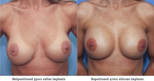 Breast Revision Before & After Gallery - Patient 58179102 - Image 1