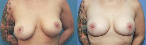 Breast Revision Before & After Gallery - Patient 58179107 - Image 1