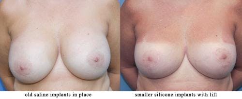 Breast Implant Revision Before & After Gallery - Patient 58179108 - Image 1