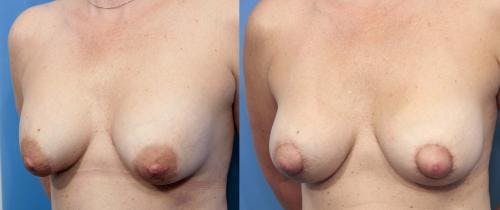 Breast Revision Before & After Gallery - Patient 58179110 - Image 1