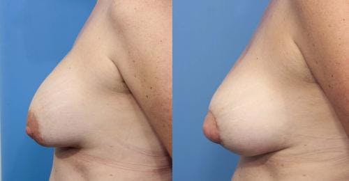Breast Revision Before & After Gallery - Patient 58179110 - Image 3