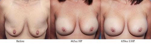 Breast Revision Before & After Gallery - Patient 58179111 - Image 1