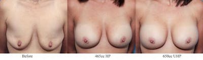 Breast Revision Before & After Gallery - Patient 58179111 - Image 1