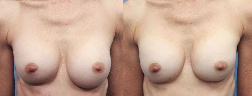 Breast Revision Before & After Gallery - Patient 58179112 - Image 1