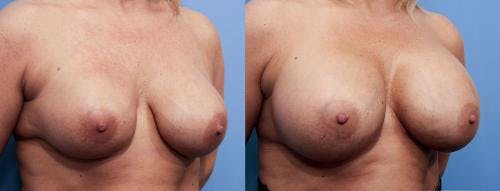 Breast Revision Before & After Gallery - Patient 58179114 - Image 2