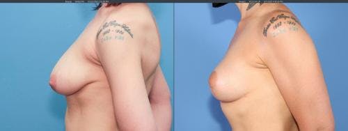 Breast Lift Before & After Gallery - Patient 58179115 - Image 2