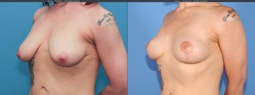 Breast Lift Before & After Gallery - Patient 58179115 - Image 3