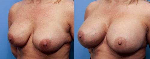 Breast Revision Before & After Gallery - Patient 58179114 - Image 4