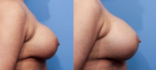 Breast Revision Before & After Gallery - Patient 58179114 - Image 5