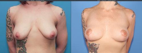 Breast Lift Before & After Gallery - Patient 58179115 - Image 1
